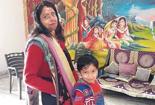 Aaj Ki Naari_Womanhood_Acid Victims-Mohini Kumar