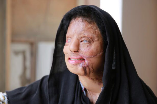 Aaj Ki Naari_Womanhood_Acid Victims-Sonali Mukherjee